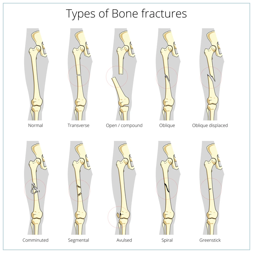 Illustrated types of bone fractures