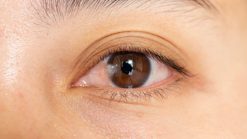 pterygium photo